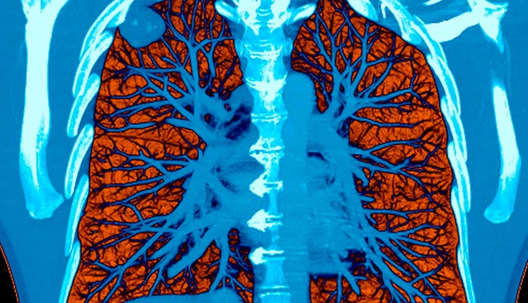 Штучний інтелект Google розпізнає рак легень не гірше лікаря
